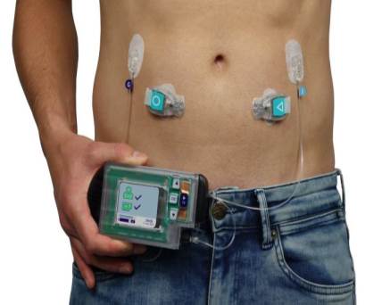 Artificial-pancreas-from-Dutch-Inreda-Diabetic-likely-to-be-on-the-market-in-2024